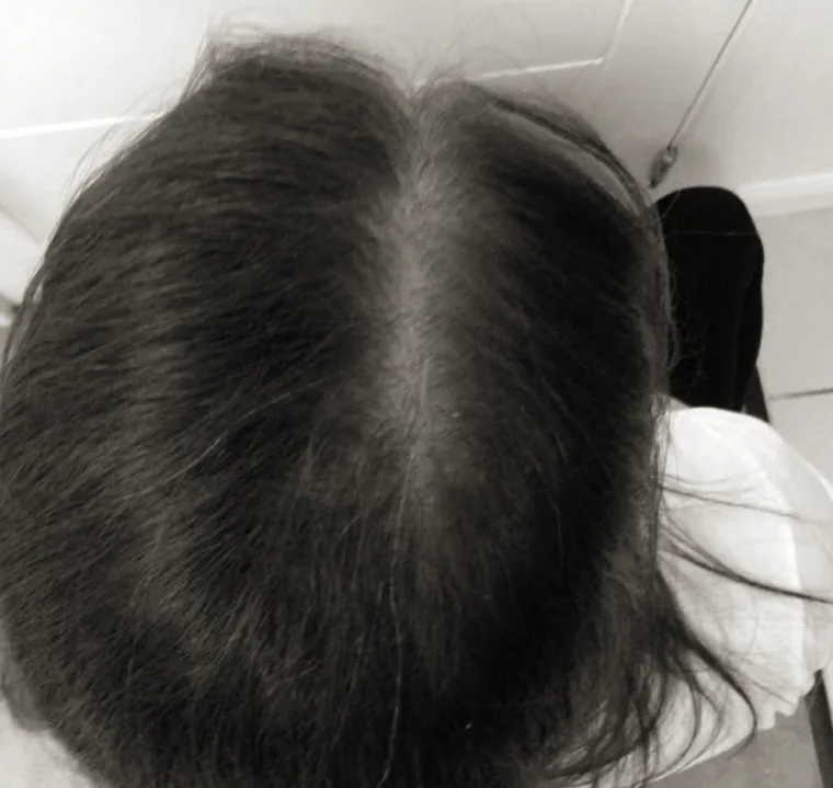 The same patient with a narrower parting and improved density after treatment