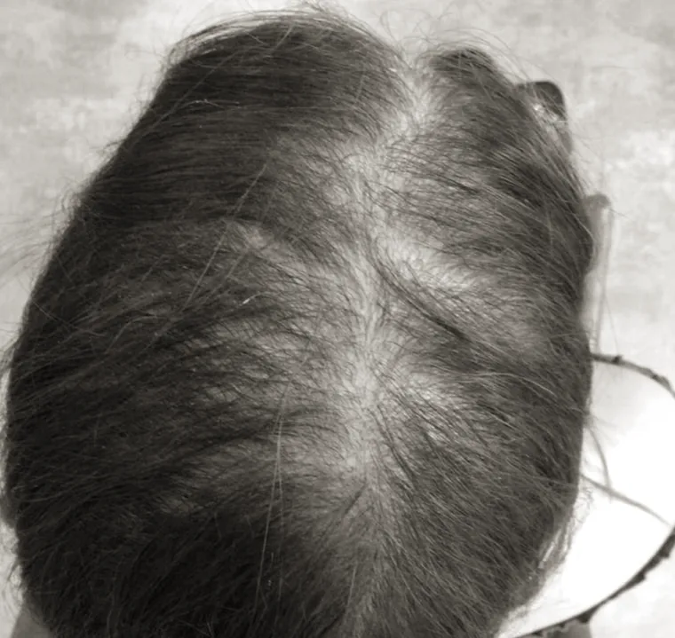 Female patient mid scalp with a wide visible parting before treatment