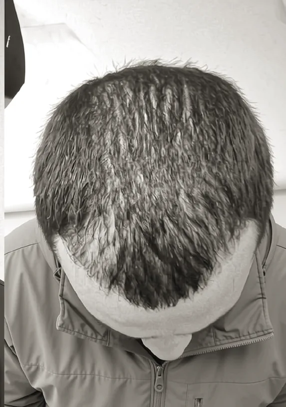 The same patient after treatment, with noticeably denser frontal coverage