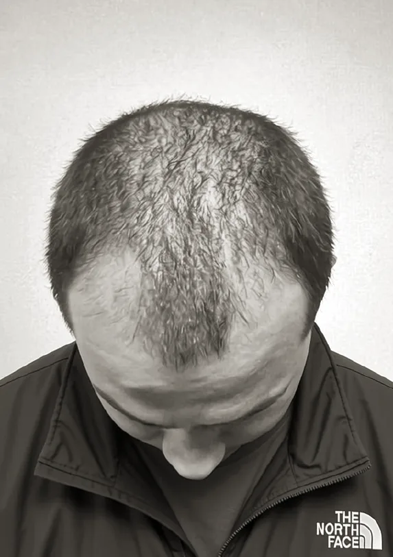 Male patient frontal hairline showing thinning and visible scalp before treatment