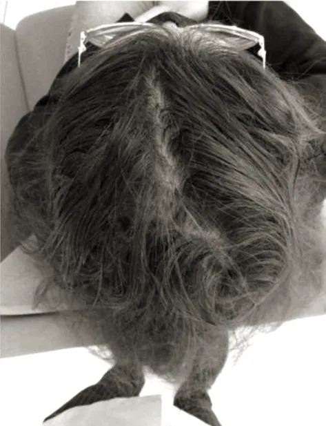 The same patient after treatment, with the parting narrowed and density restored