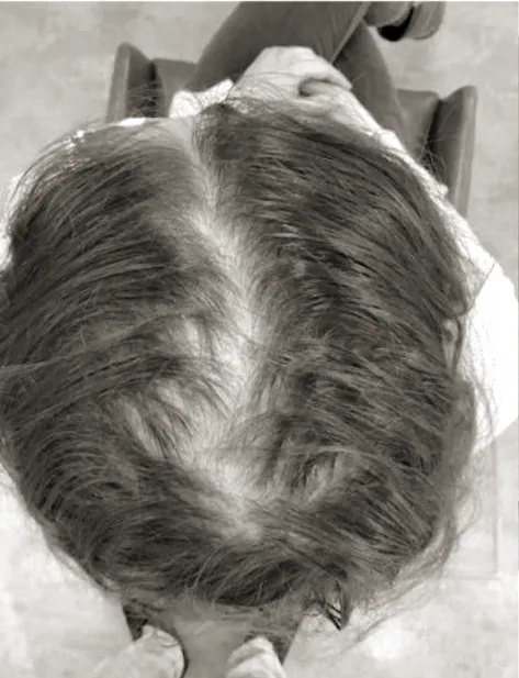 Female patient crown showing a widened parting and diffuse thinning before treatment